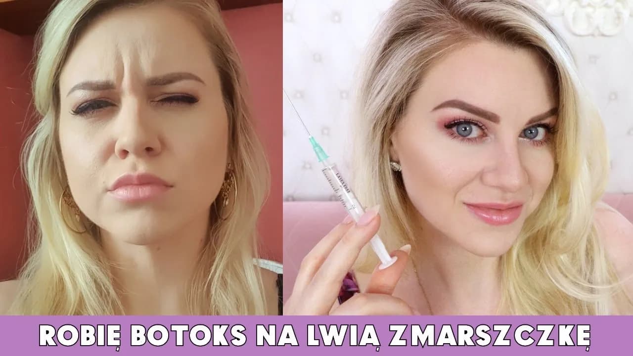 Ile kosztuje botoks na lwią zmarszczkę? Ceny w Polsce i ważne informacje