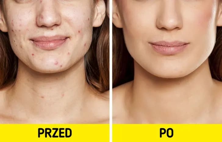 Jak pozbyć się pryszczy w kilka godzin - skuteczne i szybkie metody