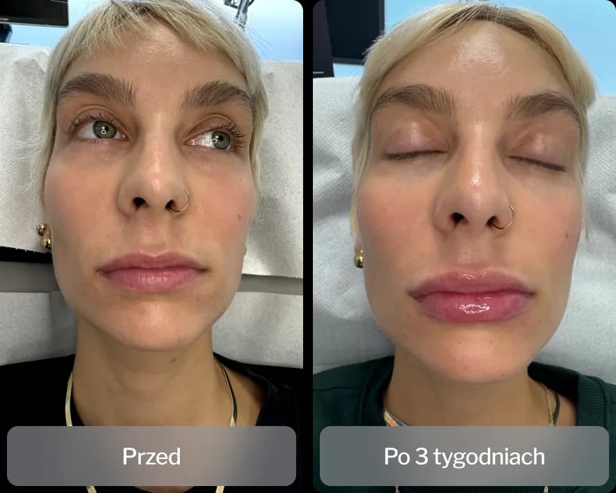 Kiedy efekt po kwasie hialuronowym? Oczekiwane rezultaty i czas działania