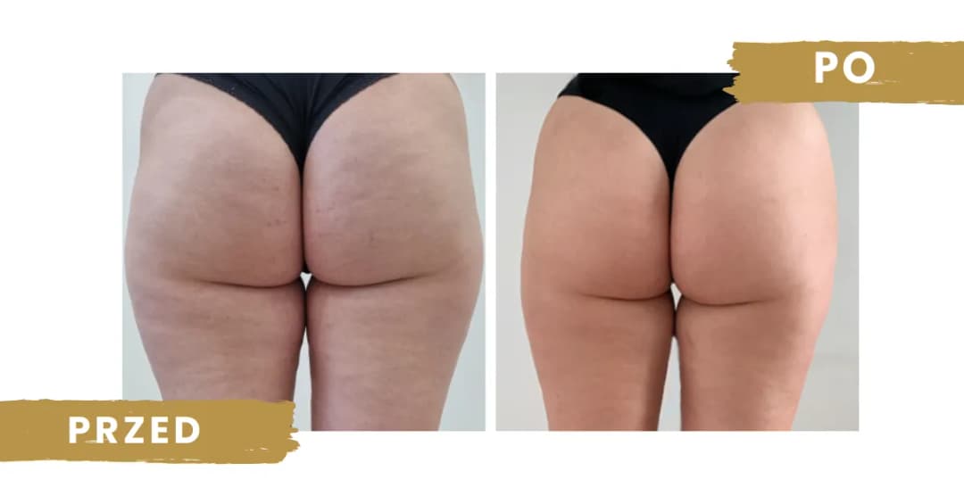 Skuteczne sposoby na cellulit na pośladkach – jak się pozbyć?