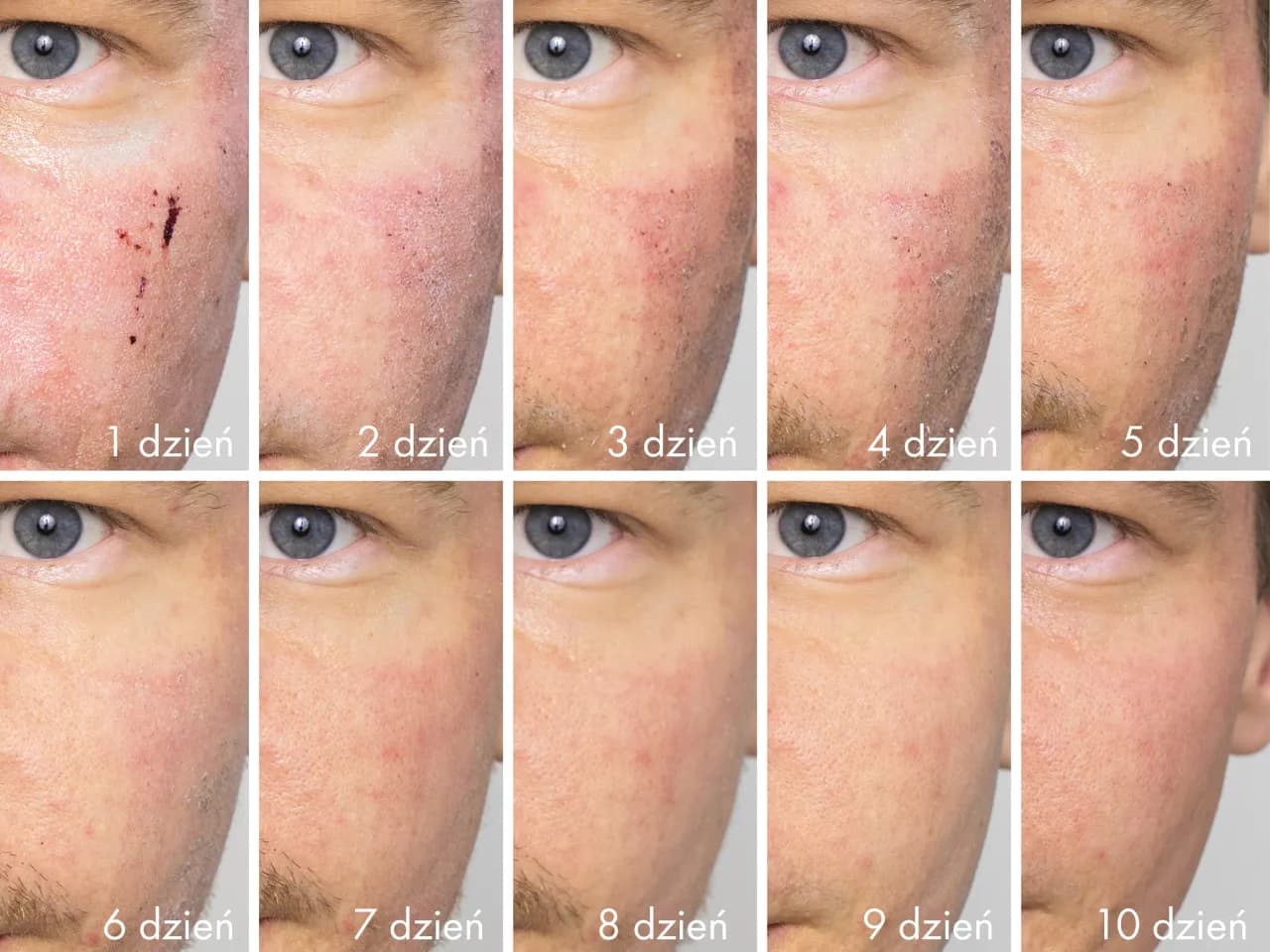 Laser frakcyjny na co pomaga - skuteczne rozwiązania dla Twojej skóry