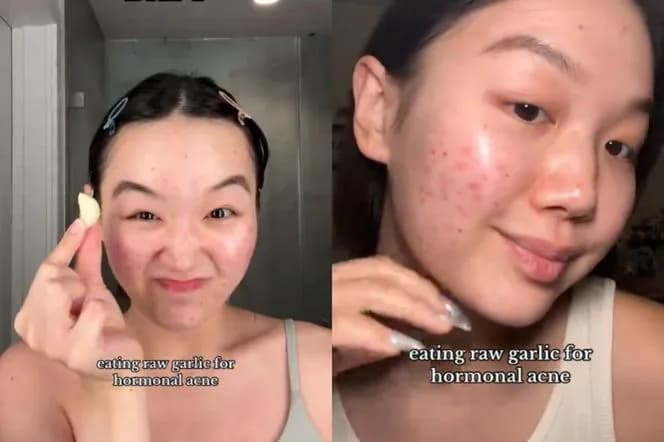 Skuteczne metody na pryszcze - co naprawdę pomaga w walce z trądzikiem