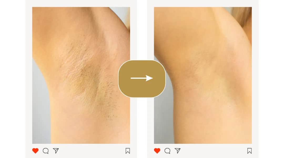 Jak pielęgnować skórę po depilacji depilatorem, aby uniknąć podrażnień