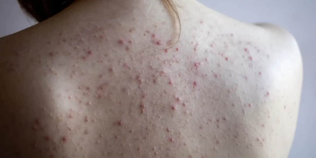 Pryszcze objawy ciąży: co musisz wiedzieć o trądziku w ciąży