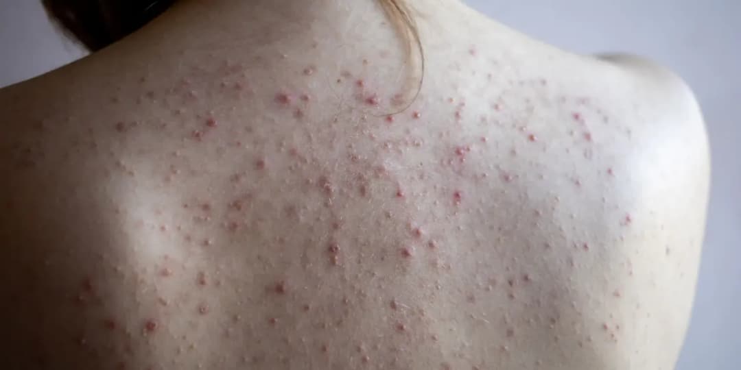 Pryszcze objawy ciąży: co musisz wiedzieć o trądziku w ciąży