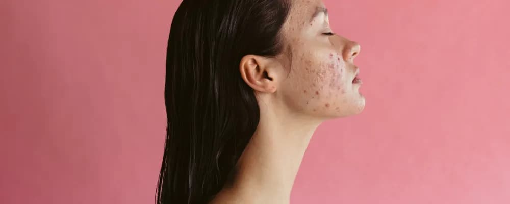 Jak pozbyć się blizn po pryszczach - skuteczne metody i porady