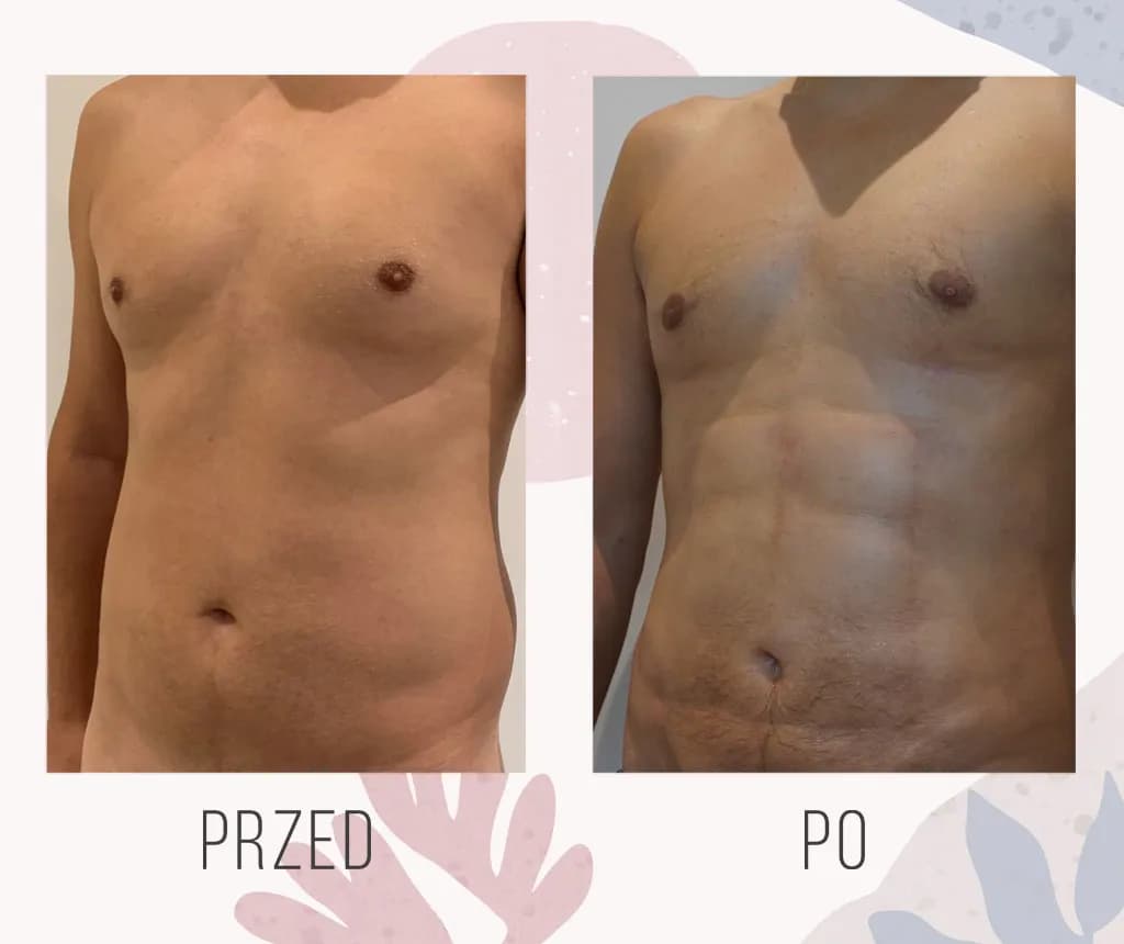 Ile kosztuje zabieg liposukcji? Sprawdź ceny i ukryte koszty