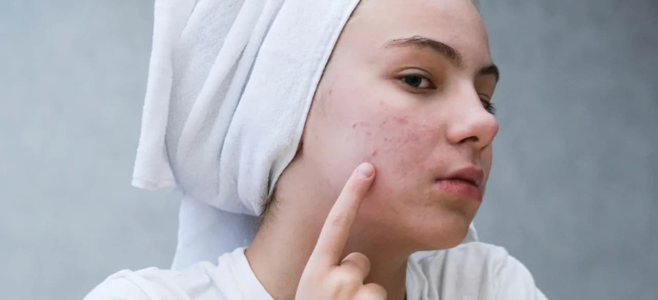 Jak pozbyć się pryszcza pod skórą i uniknąć blizn oraz bólu