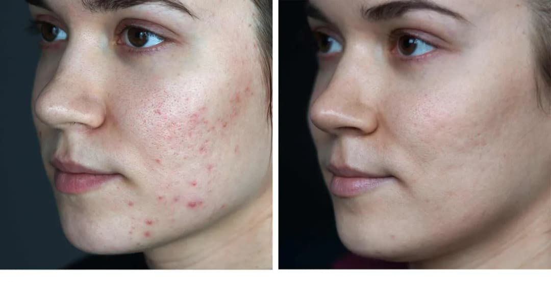 Skuteczne metody na blizny po pryszczach – jak je zredukować?