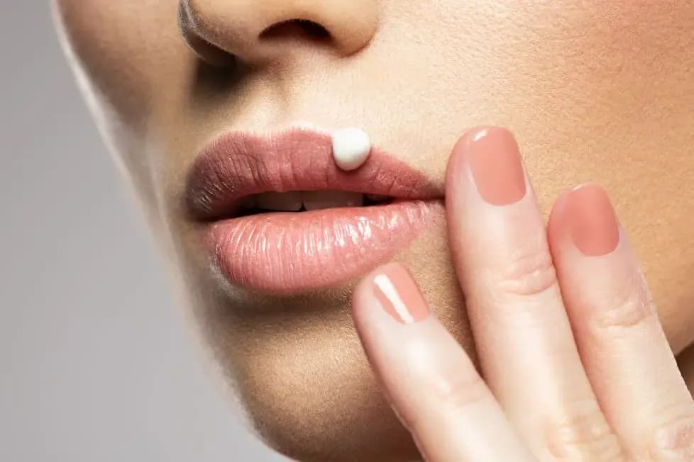 Jak skutecznie pozbyć się pryszcza na ustach i uniknąć bólu
