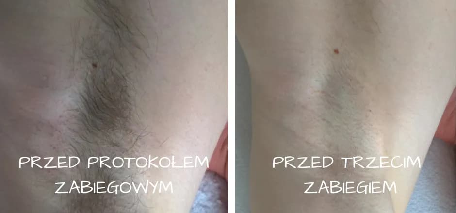 Ile zabiegów depilacji SHR potrzebujesz dla trwałych efektów?