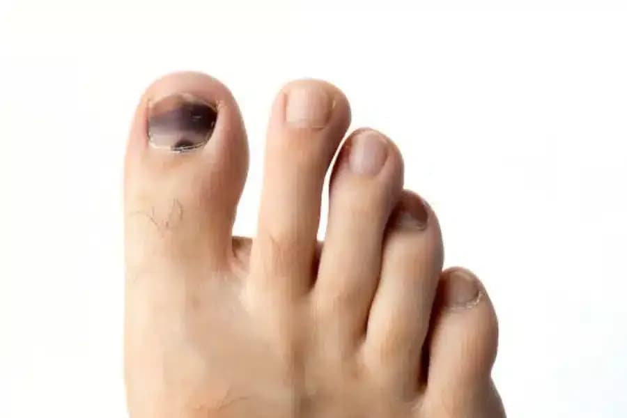 Jak schodzi paznokieć po uderzeniu? Objawy, leczenie i regeneracja