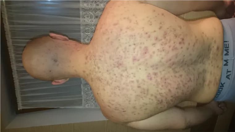 Jak skutecznie leczyć pryszcze po sterydach i odzyskać zdrową skórę