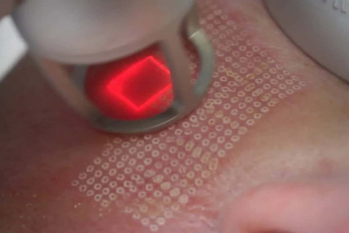 Jak wygląda zabieg laser frakcyjny? Efekty i co warto wiedzieć