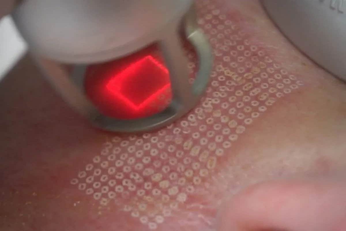 Jak wygląda zabieg laser frakcyjny? Efekty i co warto wiedzieć