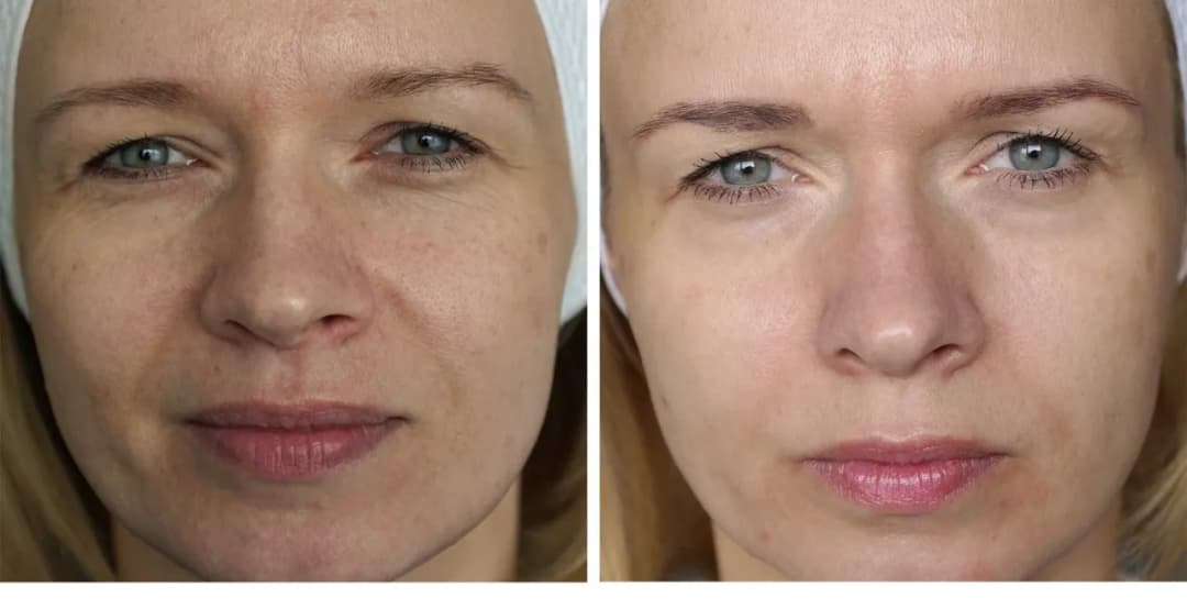 Kiedy widać efekty po laserze frakcyjnym? Poznaj pełny czas poprawy