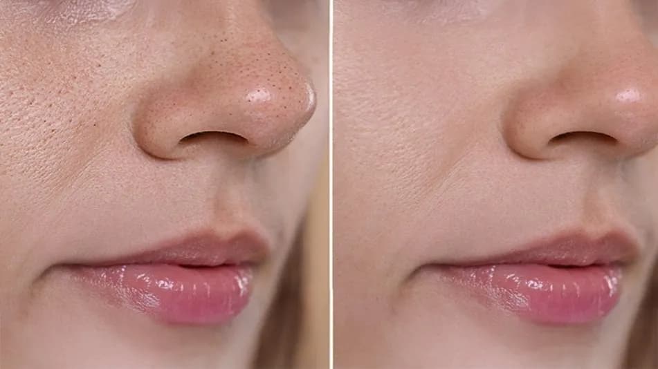 Jak pozbyć się pryszcza, który jeszcze nie wyszedł, zanim się pojawi